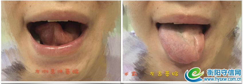 术前照片，左侧舌头萎缩，不能上抬，不能右侧伸舌