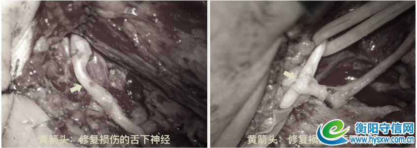 术中照片，高倍显微镜下，神经移植吻合修复损伤的舌下神经