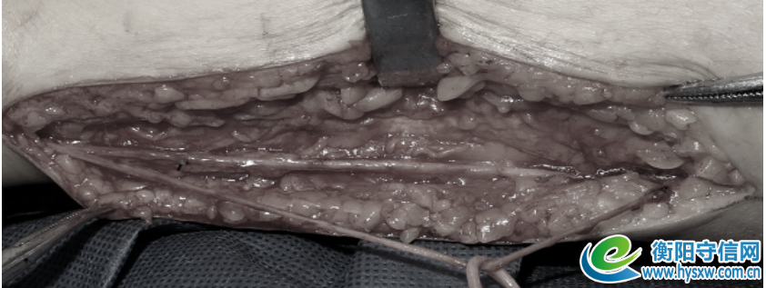 术中照片，取18厘米长，腓肠神经移植