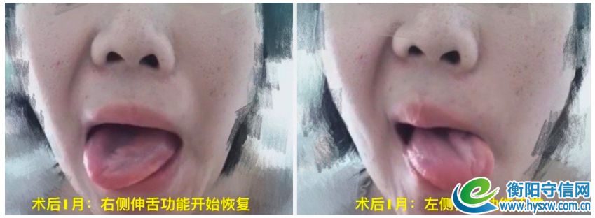 术后恢复中照片，左侧舌头饱满，开始出现运动；右侧舌头功能无明显影响